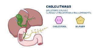 Which is a Clinical Manifestation of Cholelithiasis: Essential Insights