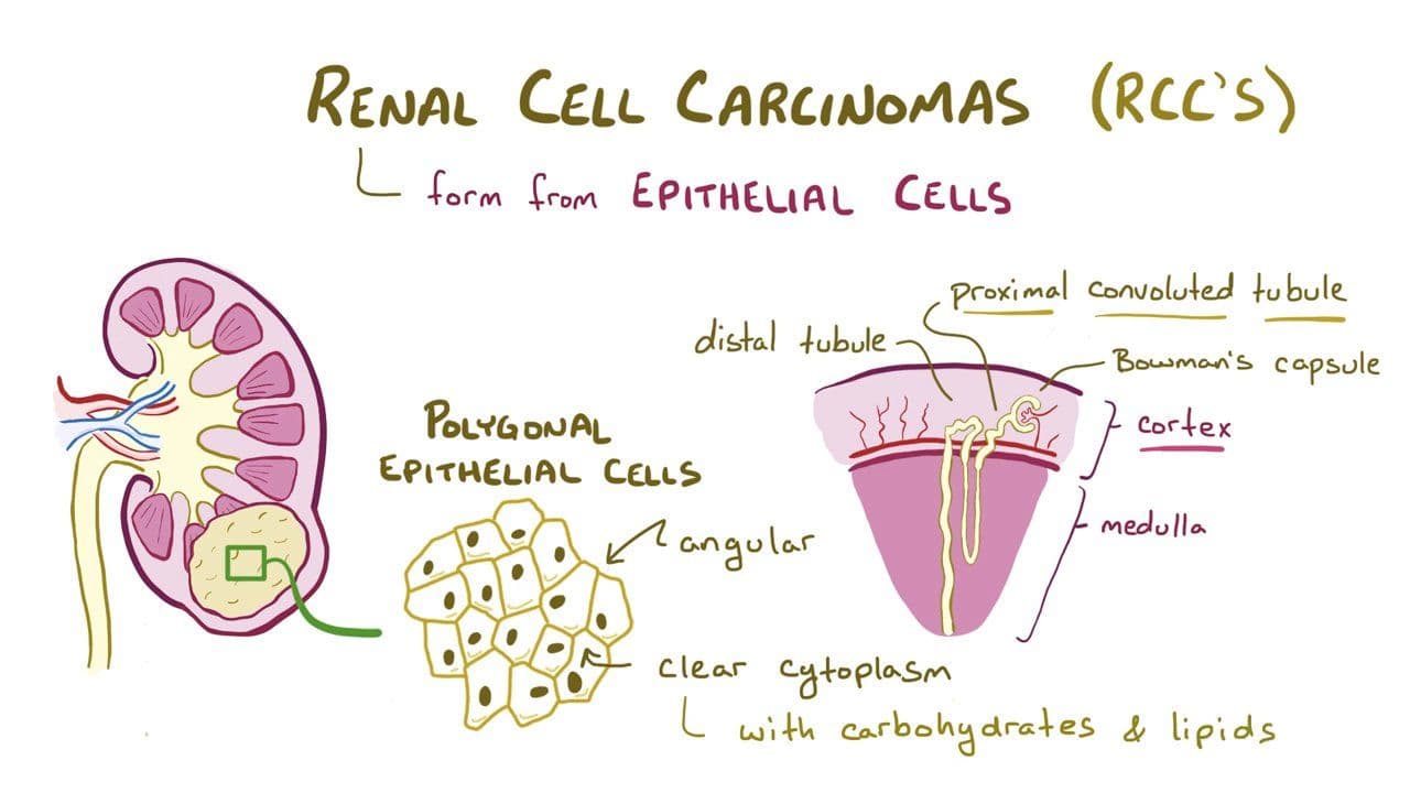 Renal cell carcinoma: Video, Anatomy & Definition | Osmosis