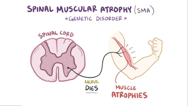 Spinal muscular atrophy: Video, Anatomy & Definition | Osmosis