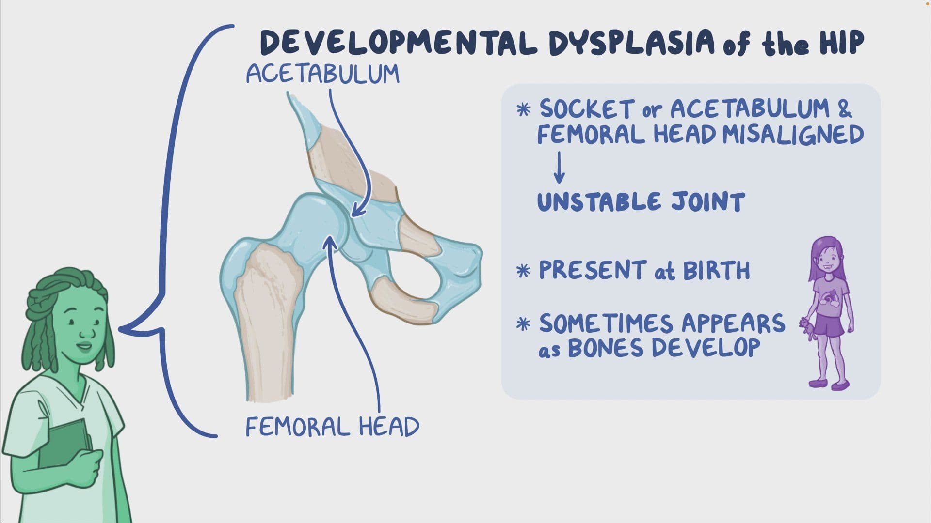 View of Developmental dysplasia of the hip: Nursing - Osmosis Video Library