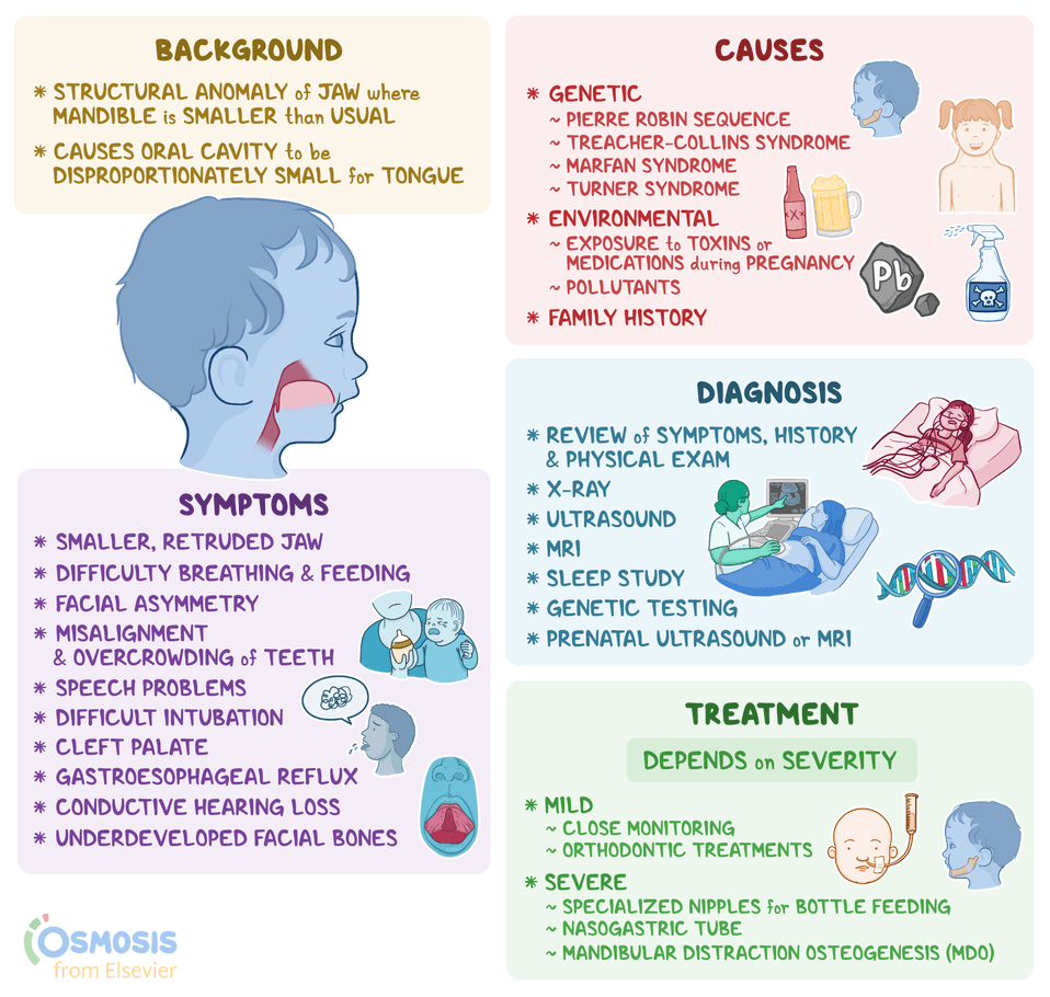 Micrognathia What Is It Diagnosis Treatment And More Osmosis Micrognathia What Is It Diagnosis Treatment And More Osmosis