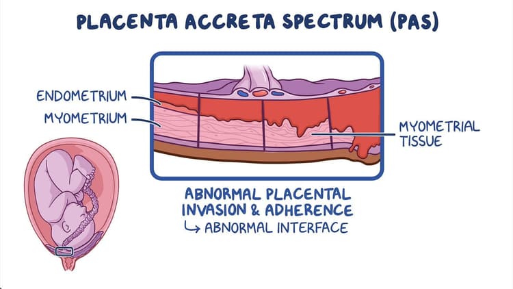 Placenta accreta spectrum: Clinical sciences - Osmosis Video Library