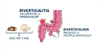 Diverticulitis Diet: What Is It, Food to Include and Avoid, and More | Osmosis Diverticulitis Diet: What Is It, Food to Include and Avoid, and More | Osmosis