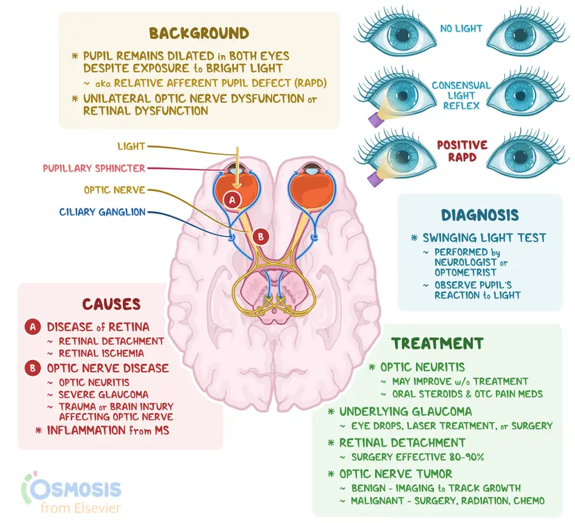 Marcus Gunn Pupil What Is It Causes Treatment And More Osmosis marcus-gunn-pupil-what-is-it-causes-treatment-and-more-osmosis