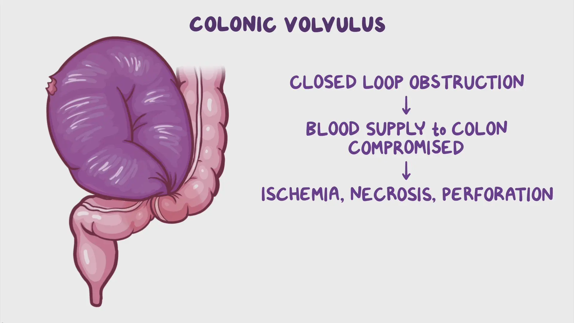 Looping Colon Colonic volvulus: Video & Meaning | Osmosis