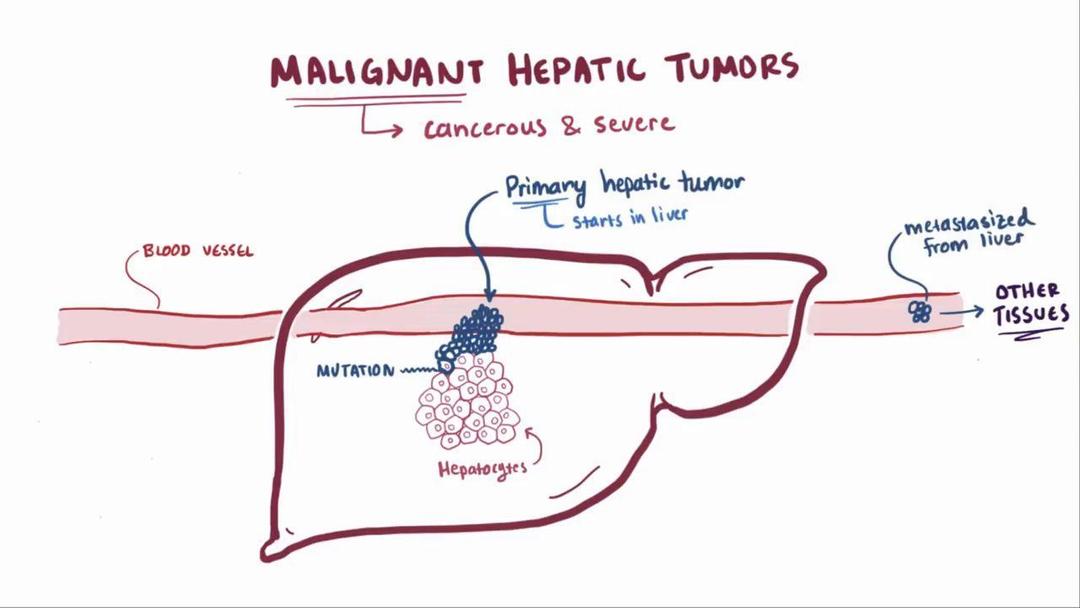 Hepatocellular Carcinoma Video Causes Meaning Osmosis hepatocellular-carcinoma-video-causes-meaning-osmosis