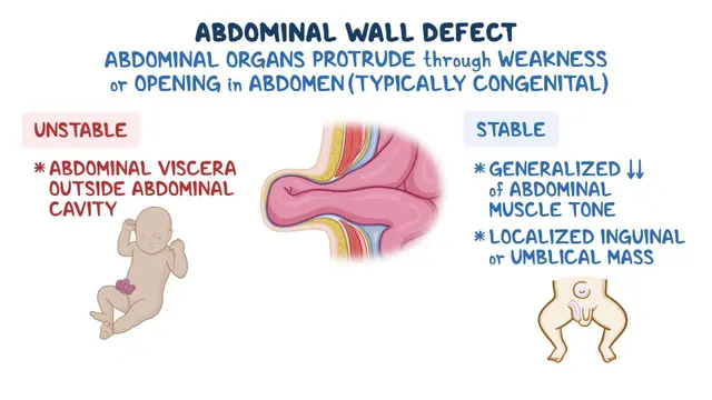 Protusion Defect Approach to abdominal wall defects: Video & Meaning | Osmosis