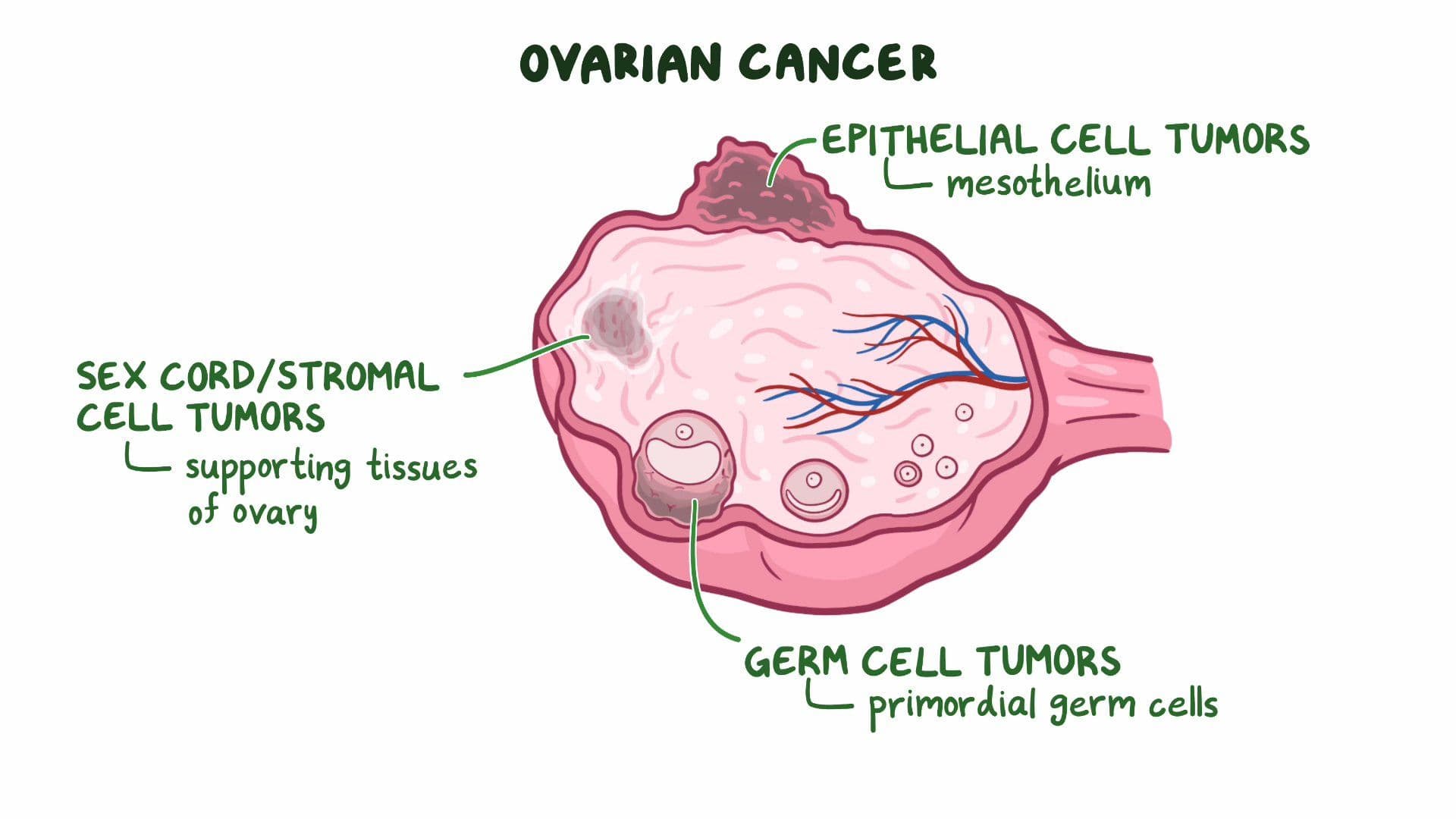 Ovarian Cancer Clinical Sciences Osmosis Video Library ovarian-cancer-clinical-sciences-osmosis-video-library