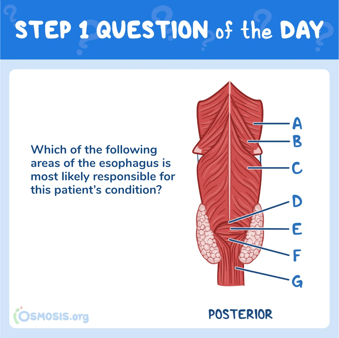USMLE® Step 1 Question of the Day: Zenker’s Diverticulum