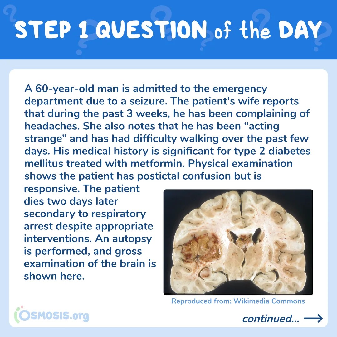 USMLE® Step 1 Question of the Day: Glioblastoma Multiforme
