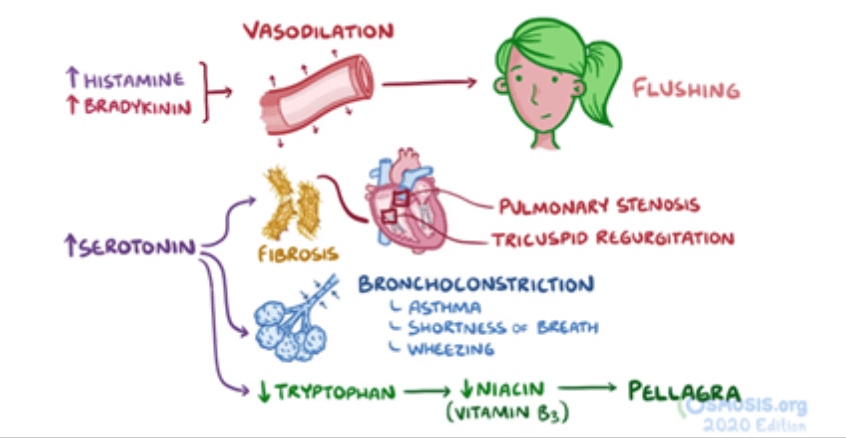 USMLE® Step 1 Question of the Day: Somatostatin analog - Osmosis Blog