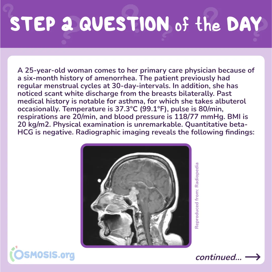 USMLE® Step 2 CK Question of the Day: Prolactinoma