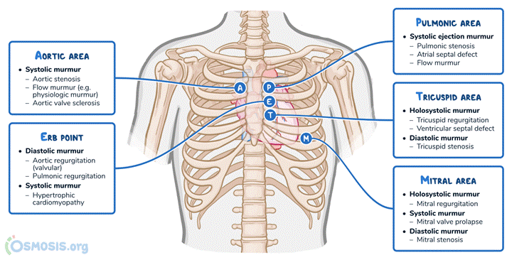 Osmosis.org style illustration of cardiac auscultation areas on the chest, labeling the aortic, pulmonic, Erb’s point, tricuspid, and mitral listening locations and listing associated systolic, diastolic, and holosystolic heart murmurs.