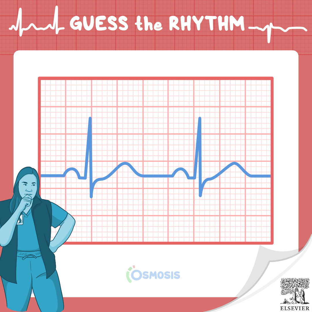 Guess the Rhythm: Normal sinus rhythm (NSR)
