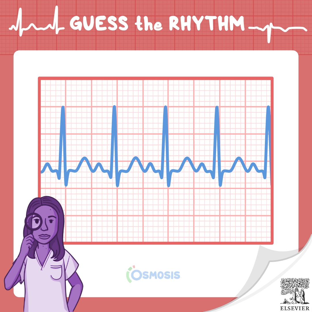 Guess the Rhythm: Sinus tachycardia