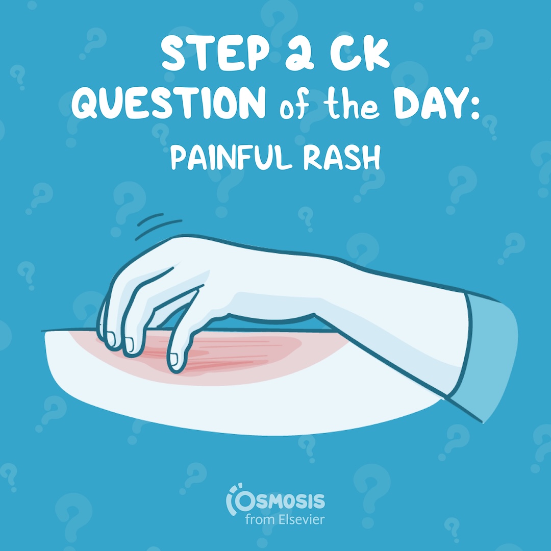 USMLE® Step 2 CK Question of the Day: Painful rash