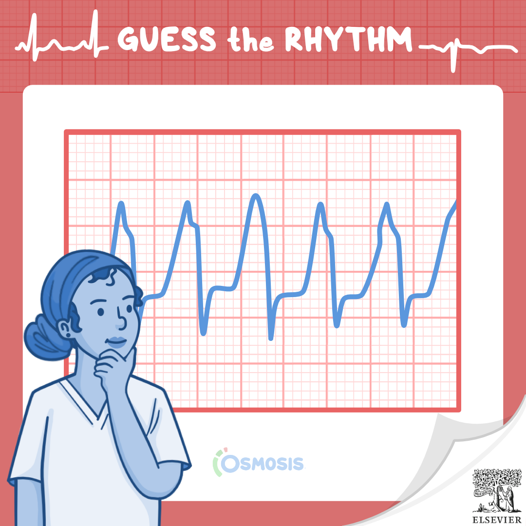 Guess the Rhythm: Ventricular tachycardia