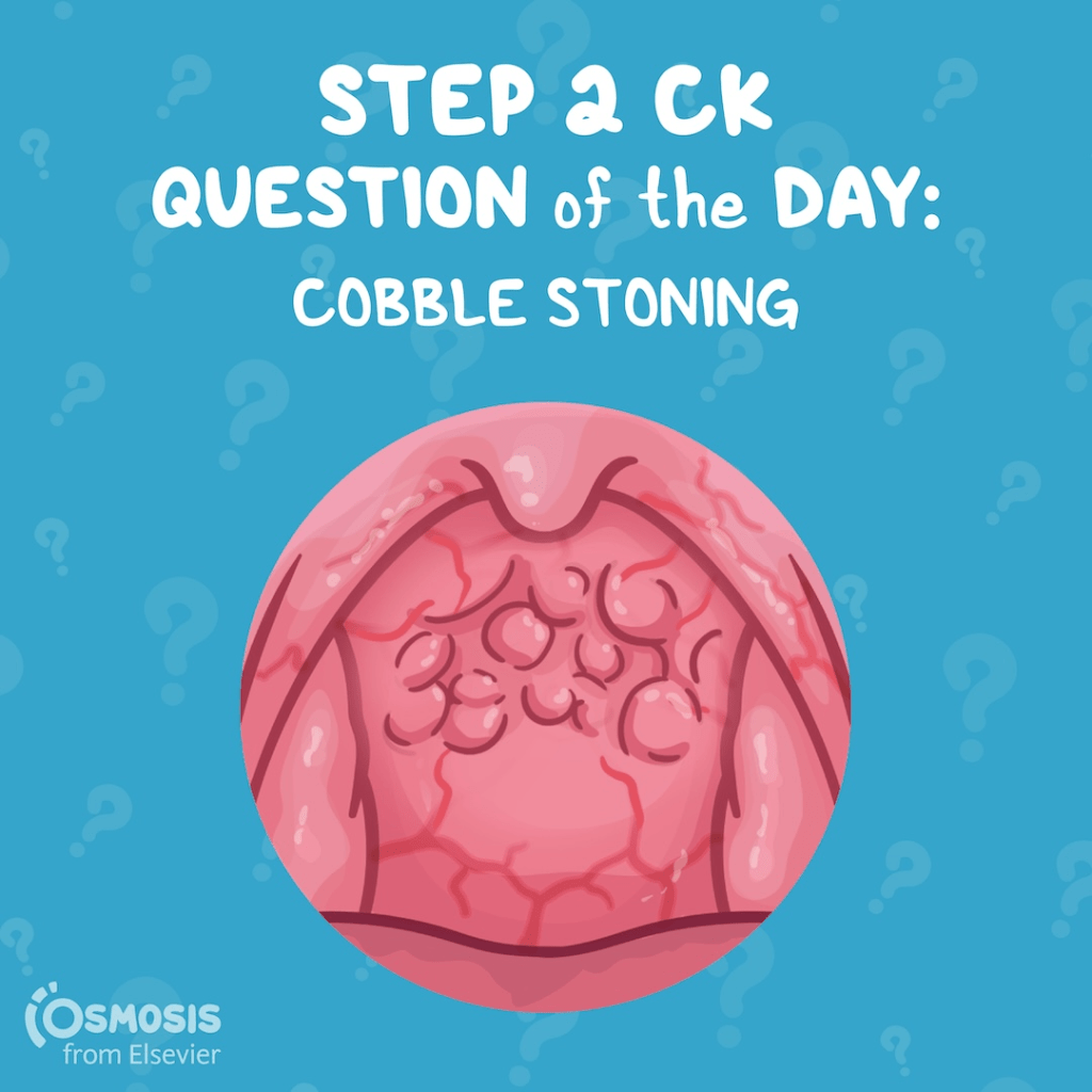 USMLE® Step 2 CK Question of the Day: Cobble stoning