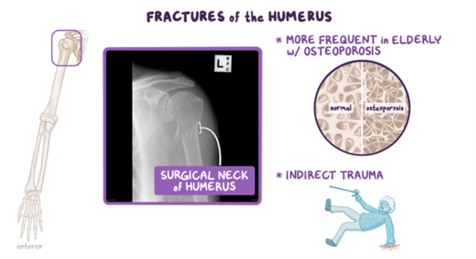 FRACTURES OF THE HUMERUS
* (Image of shoulder) Surgical neck of Humerus
* More frequent in elderly with Osteoporosis (slide of normal bone density vs with Osteoporosis)
* Indirect trauma