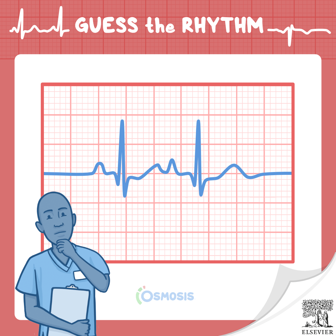 Guess the Rhythm: Atrial flutter