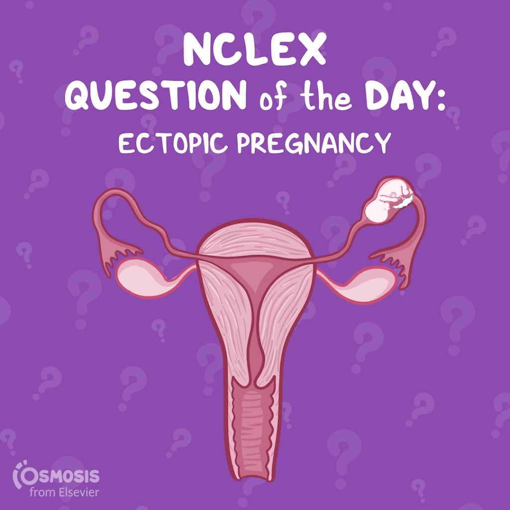 NCLEX-RN® Question of the Day: Ectopic pregnancy