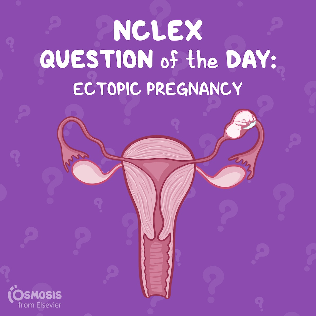NCLEX-RN® Question of the Day: Ectopic pregnancy