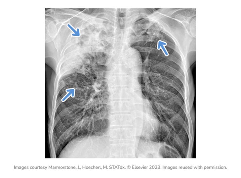 Frontal chest X-ray showing both lungs with multiple patchy areas of increased opacity. Blue arrows highlight regions of airspace consolidation in the upper and mid lung fields bilaterally, more prominent on the right. The findings suggest multifocal pulmonary infiltrates. The heart and mediastinal contours appear centered and without obvious enlargement.