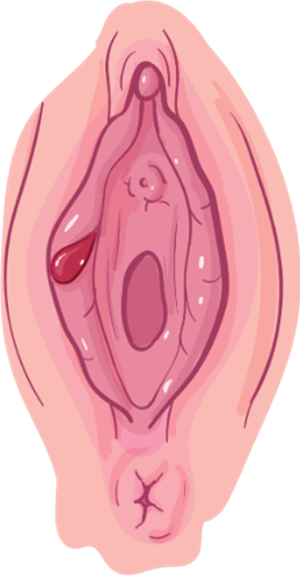 Medical-style illustration of external female genital anatomy (the vulva), showing the labia, clitoral area, vaginal opening, and surrounding structures, with a small highlighted lesion on one side for educational or clinical reference.