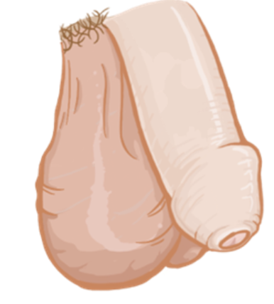 Medical-style illustration of external male genital anatomy, showing the penis and scrotum in a simplified, neutral anatomical depiction for educational purposes.