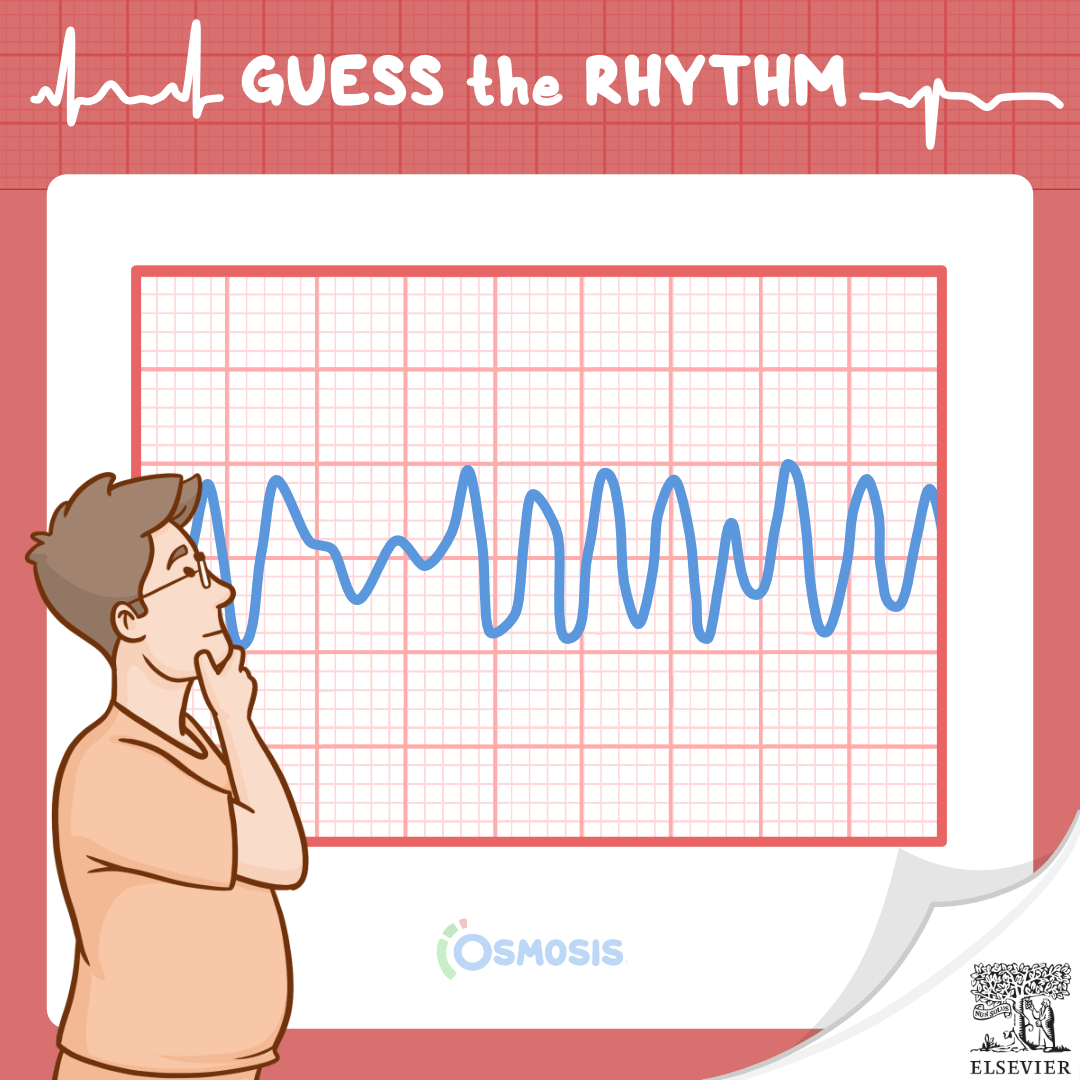 Guess the Rhythm: Ventricular fibrillation (Vfib)