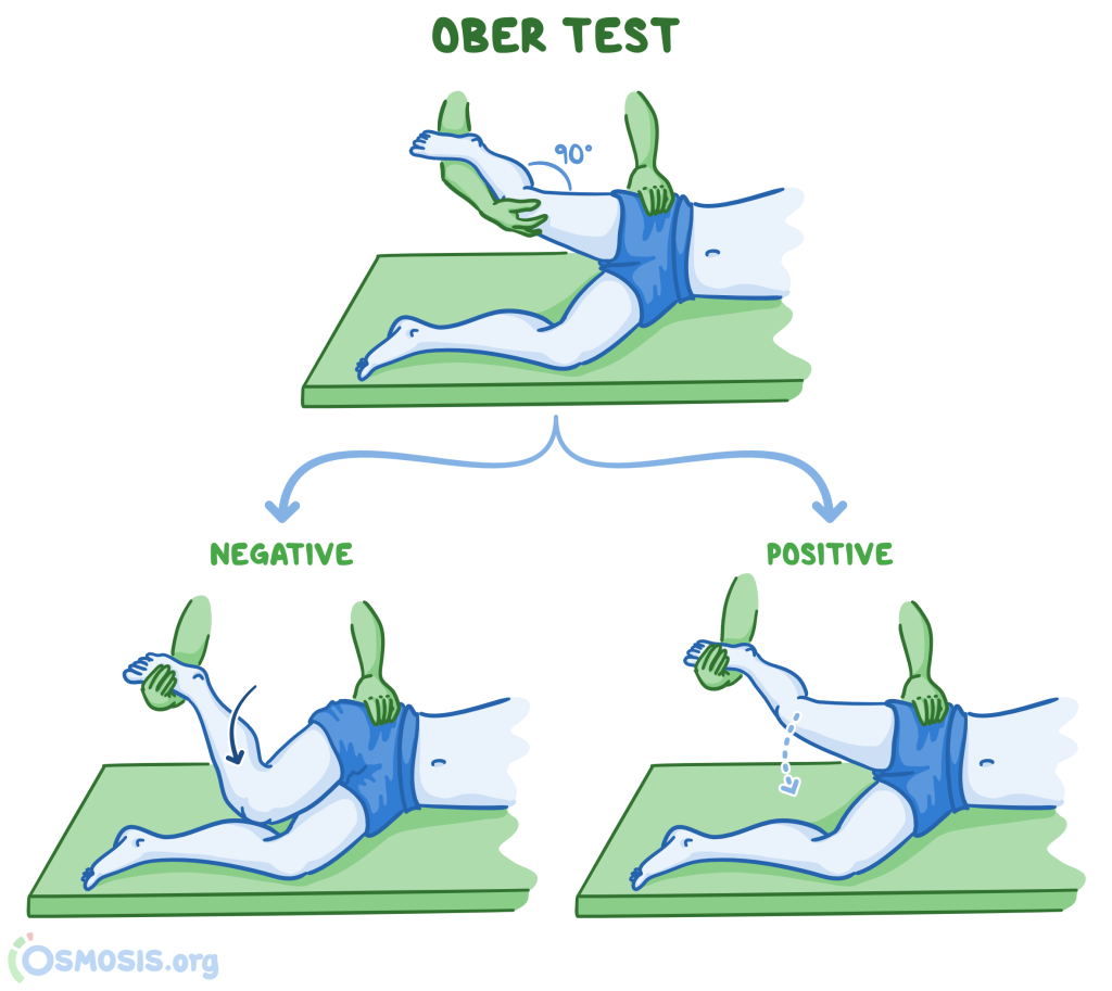 Illustration demonstrating the Ober test for iliotibial band tightness. A patient lies on their side while the examiner moves the upper leg into extension and allows it to drop. A negative result shows the leg lowering toward the table, while a positive result shows the leg remaining elevated, indicating tightness.