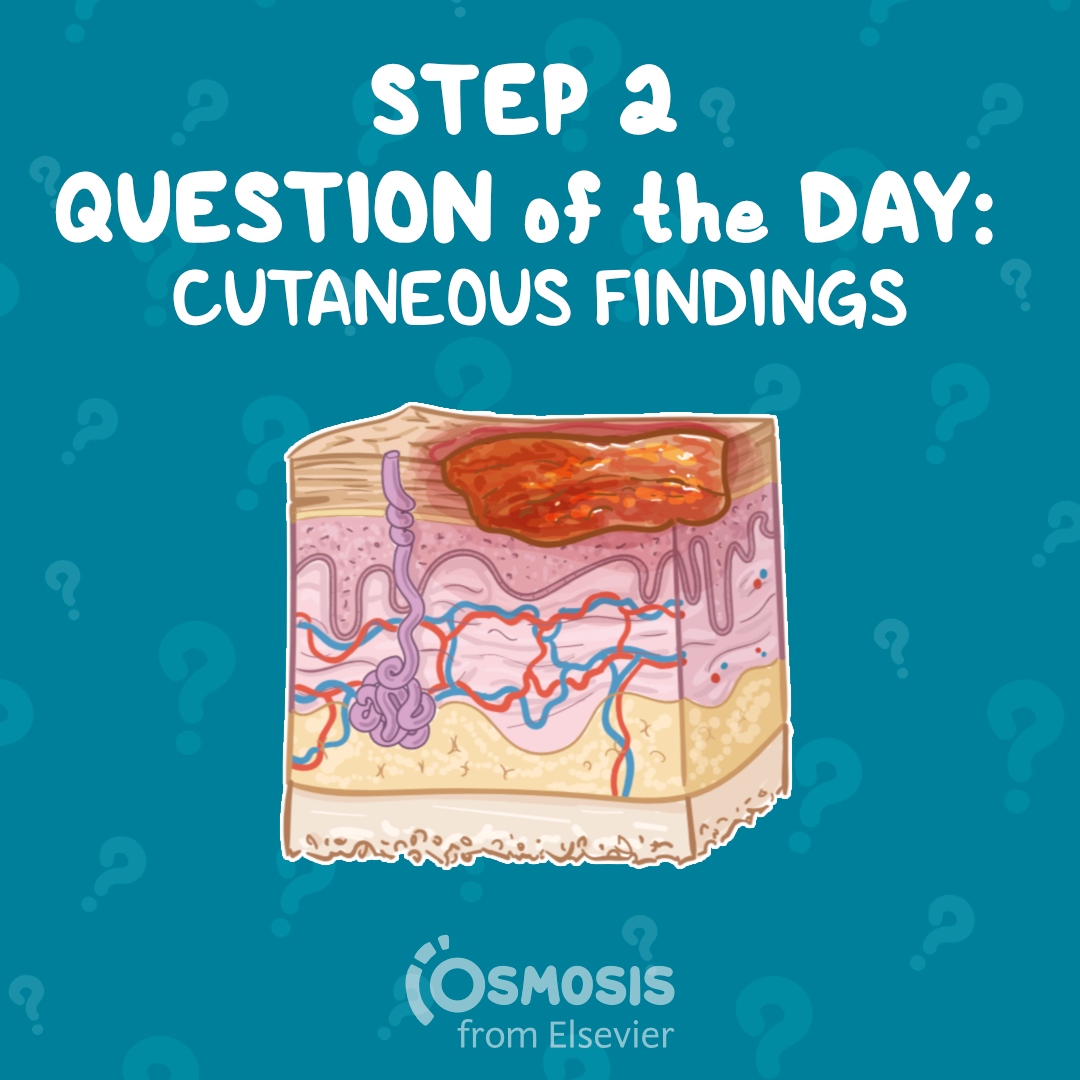 USMLE® Step 2 CK Question of the Day: Cutaneous findings