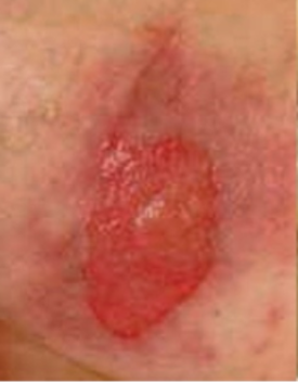 Close-up of a shallow open skin wound with a red, moist base and surrounding redness, consistent with a partial-thickness ulcer or abrasion.
