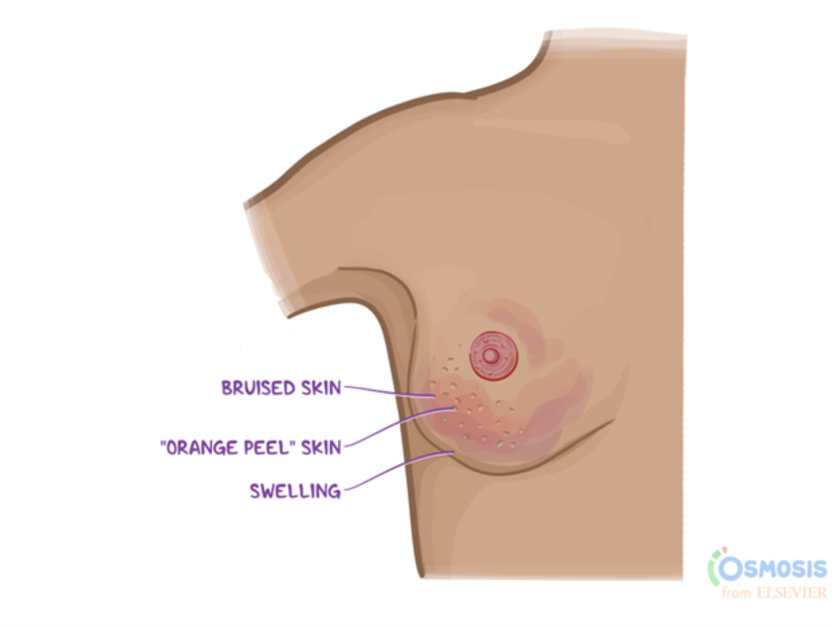 Illustration of a breast showing signs of inflammation, including bruised skin, swelling, and a dimpled “orange peel” (peau d’orange) appearance around the nipple.