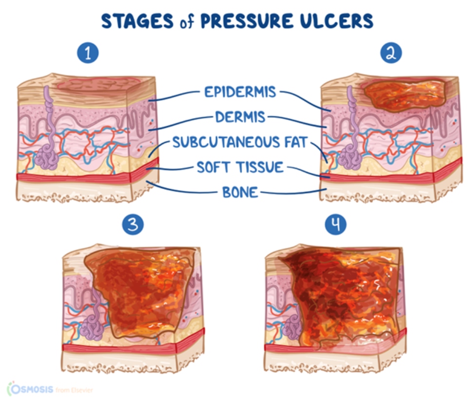 Educational illustration showing the four stages of pressure ulcers. Stage 1 shows intact skin with redness; stage 2 shows partial-thickness skin loss affecting the epidermis and dermis; stage 3 shows deeper tissue loss extending into subcutaneous fat; and stage 4 shows extensive damage reaching muscle and bone. Labels indicate skin layers including epidermis, dermis, subcutaneous fat, soft tissue, and bone.