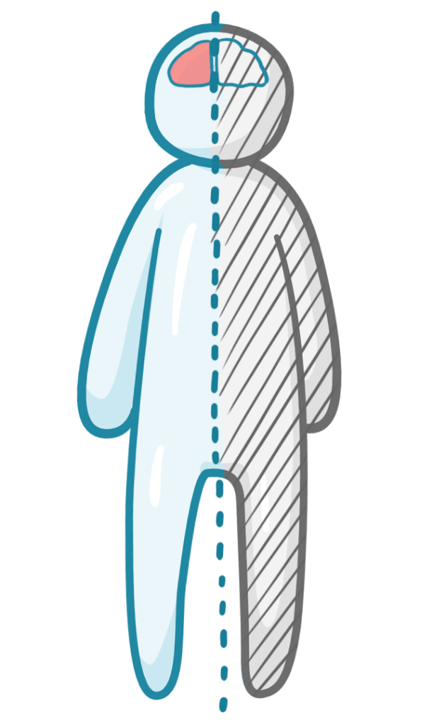 Osmosis.org illustration of a simplified human figure divided by a vertical midline, with one half of the body shaded to indicate weakness or loss of function. A highlighted region in the opposite side of the brain demonstrates the concept of contralateral neurological deficits, where injury to one cerebral hemisphere causes weakness on the opposite side of the body.