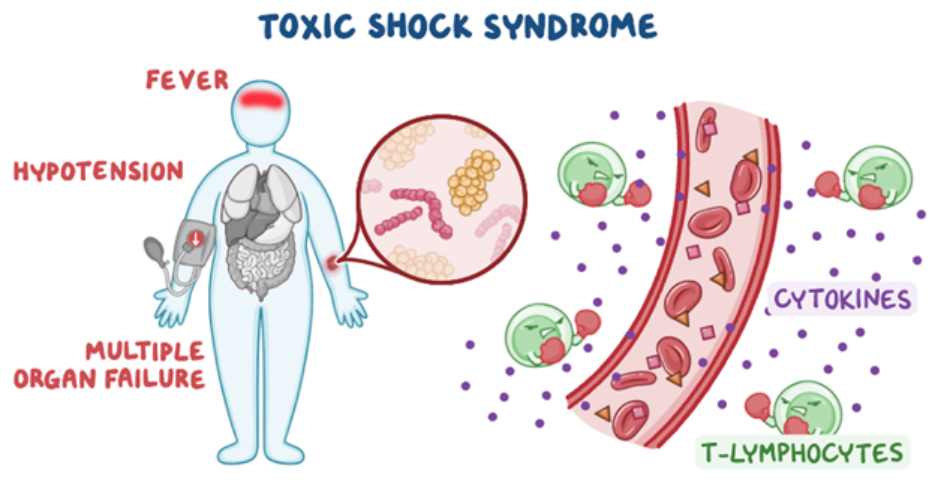 Osmosis.org educational diagram illustrating toxic shock syndrome. A human figure is shown with fever, hypotension, and multiple organ failure, alongside a magnified view of bacteria. The graphic depicts activation of T lymphocytes and widespread cytokine release into the bloodstream, illustrating the excessive immune response that leads to systemic inflammation and shock.