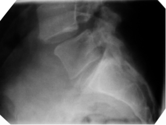 Lateral X-ray of the lower lumbar spine showing forward displacement of one vertebra relative to the vertebra below it at the lumbosacral junction, with narrowing of the intervertebral disc space. The image demonstrates abnormal spinal alignment consistent with spondylolisthesis.