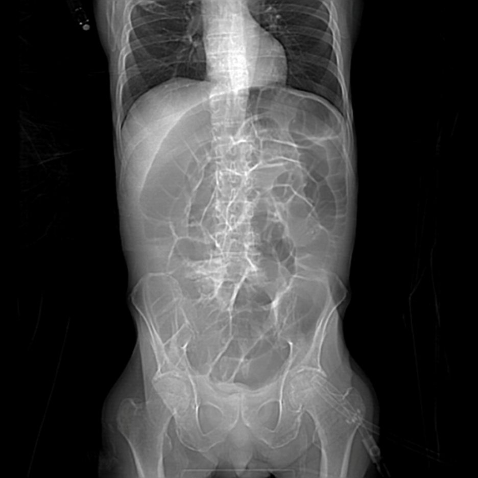 Abdominal X-ray showing multiple dilated loops of bowel throughout the abdomen and pelvis, with prominent gas-filled intestinal segments visible against the spine and abdominal organs. The image demonstrates an abnormal bowel gas pattern consistent with significant intestinal distension.