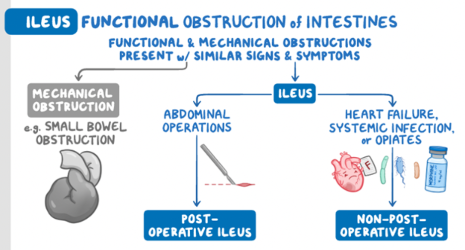 Educational diagram explaining ileus, a functional obstruction of the intestines. It compares ileus with mechanical bowel obstruction and shows common causes of ileus, including abdominal surgery (postoperative ileus) and conditions such as heart failure, systemic infection, or opioid use (non-postoperative ileus). Arrows illustrate how these factors can lead to impaired intestinal motility despite the absence of a physical blockage.