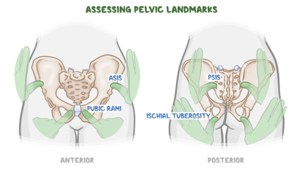 Educational illustration showing how to assess pelvic bony landmarks from the anterior and posterior views. The anterior view highlights the anterior superior iliac spines (ASIS) and pubic rami, while the posterior view highlights the posterior superior iliac spines (PSIS) and ischial tuberosities. Hand placements demonstrate where these anatomical landmarks are palpated during a physical examination.