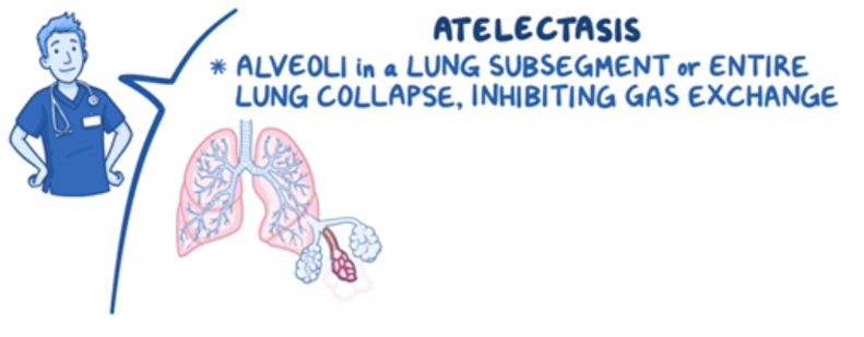 Osmosis.org educational illustration explaining atelectasis, in which alveoli in a lung subsegment or an entire lung collapse and impair gas exchange. The graphic shows the lungs with a magnified cluster of partially collapsed alveoli alongside a healthcare professional.