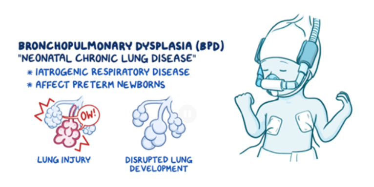 Osmosis.org educational illustration explaining bronchopulmonary dysplasia (BPD), a chronic lung disease of premature newborns. The graphic shows damaged and underdeveloped alveoli to illustrate lung injury and disrupted lung development, alongside a preterm infant receiving mechanical ventilation, representing respiratory support commonly associated with the condition.