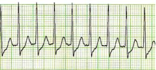 An ECG of the patient's heart.