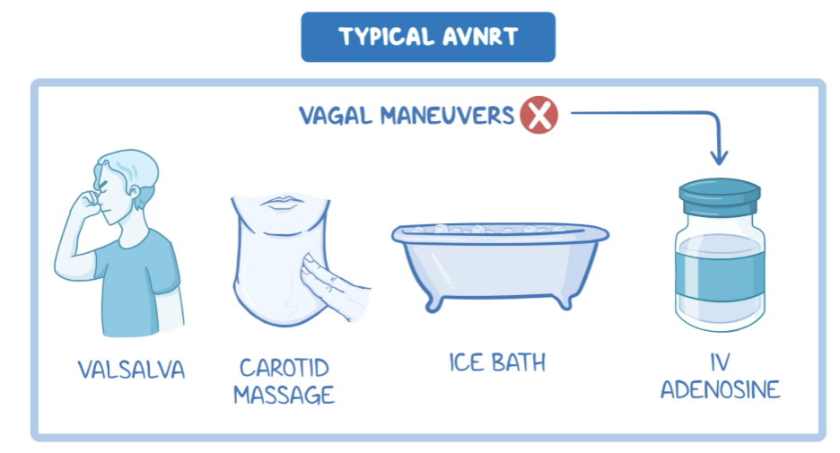 Osmosis.org style illustration showing treatment for typical AVNRT, with vagal maneuvers including the Valsalva maneuver, carotid massage, and an ice bath, followed by IV adenosine if vagal maneuvers are unsuccessful.