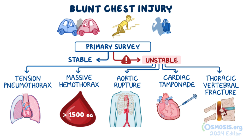 Osmosis.org style illustration flowchart of the primary survey for blunt chest injury, highlighting unstable complications including tension pneumothorax, massive hemothorax, aortic rupture, cardiac tamponade, and thoracic vertebral fracture.